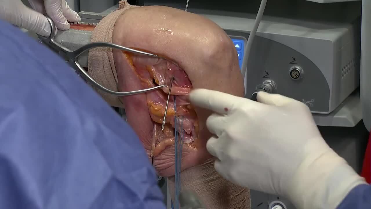 Posterolateral Corner Reconstruction using TIGHT-N Anchor