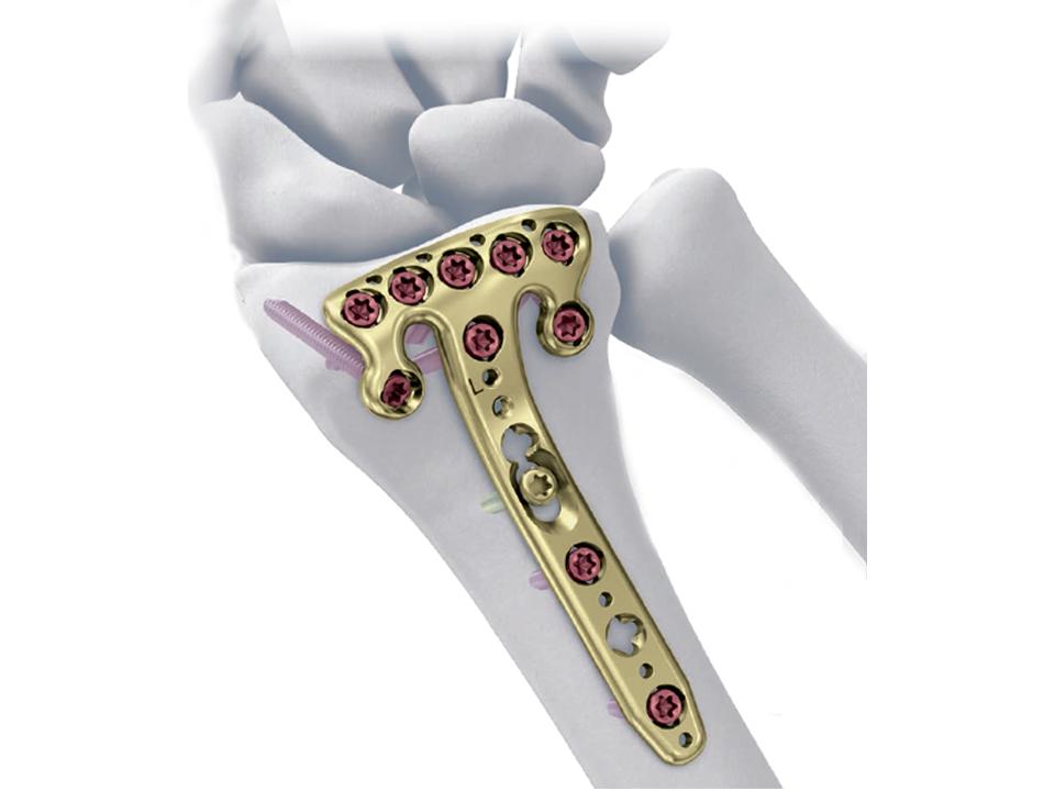 2.4mm Variable Angle LCP® Volar Rim Distal Radius System