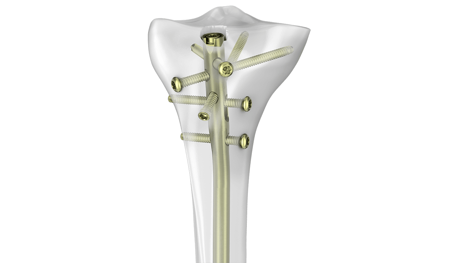 TN-ADVANCED System inside of bone