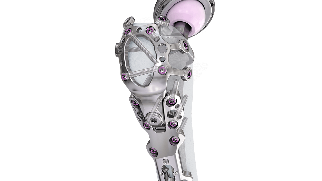 Femur Plating System fixated in bone