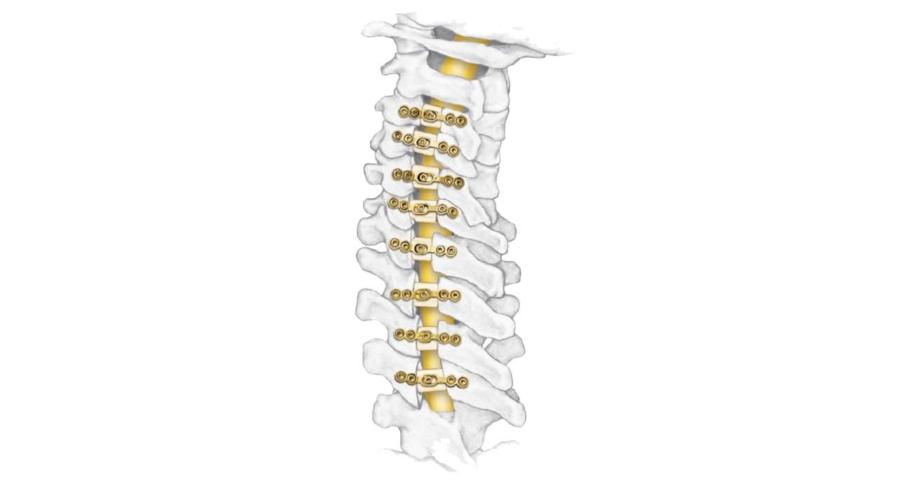 ARCH Fixation System 