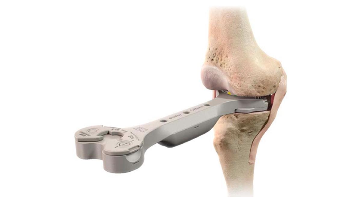 ATTUNE™ Knee System spacer block inserted into knee during total knee arthroplasty