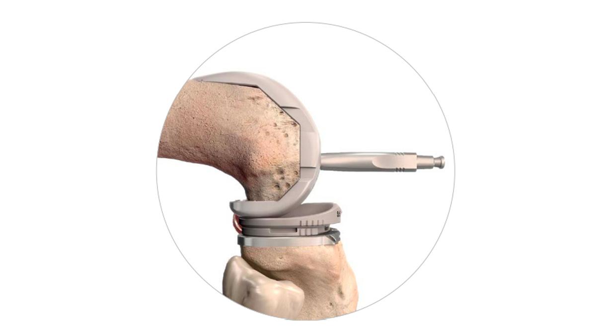 femoral lug hole drilling