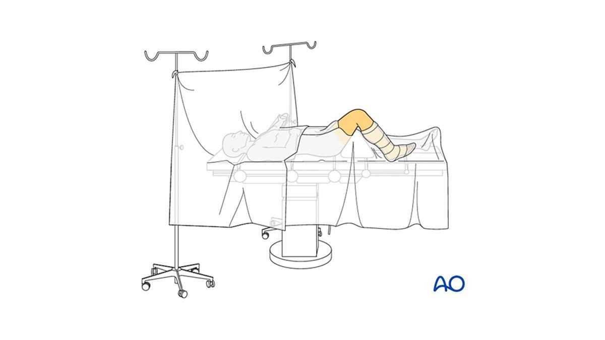 diagram of patient in supine position with knee flexed 90 degrees draped in u-drape