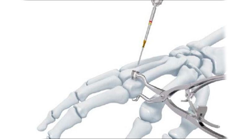 Variable Angle Locking Hand System cortex screw being attached to stardrive screwdriver shaft using screw recess
