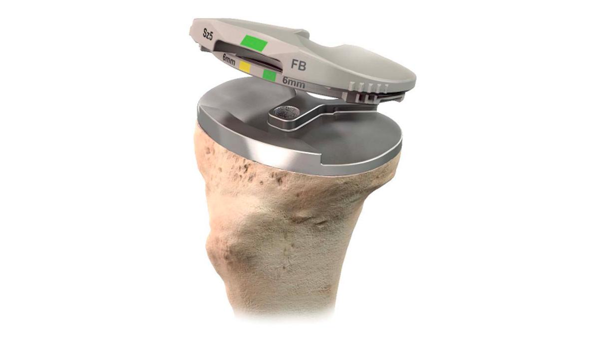 Tibial insert trial being placed into tibia