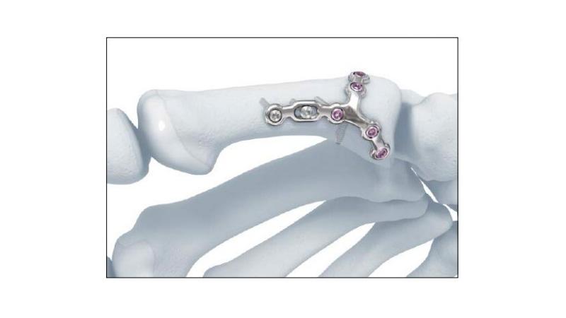 Variable Angle Locking Hand System First Metacarpal Plate Lateral Placement with screws on hand