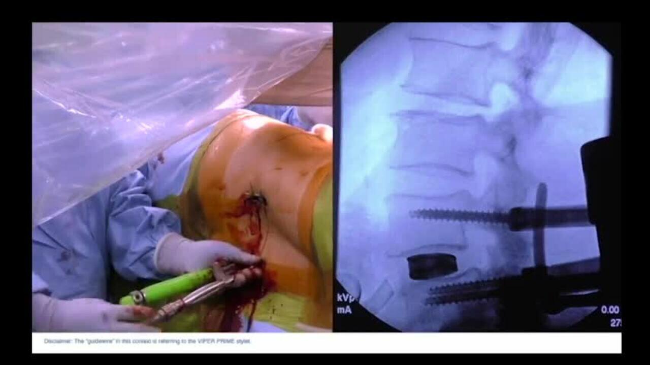 ATP Screw Placement
