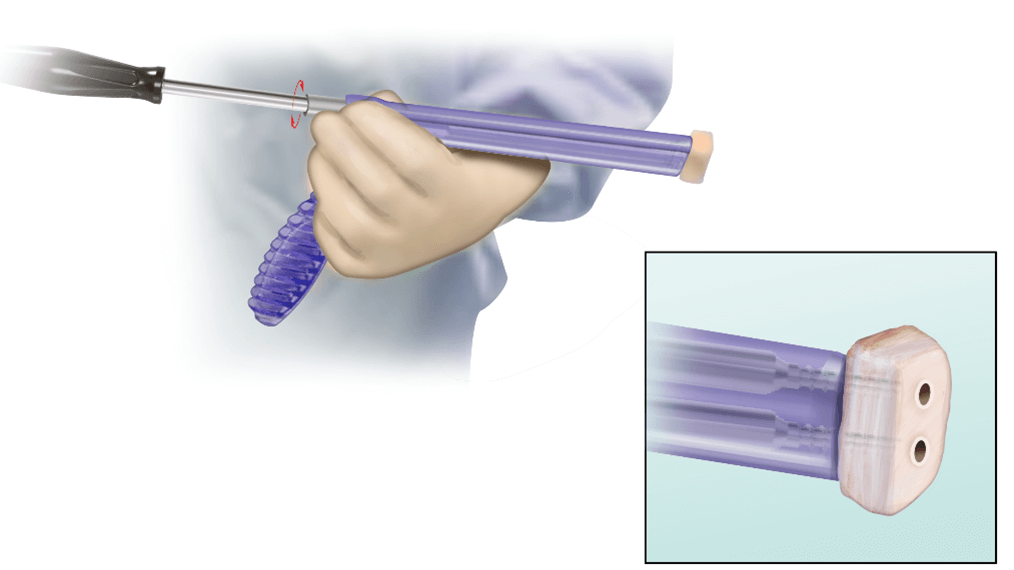Distal Tibial Allograft (DTA) Preparation 5