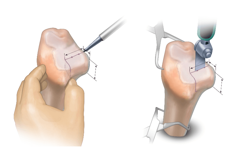 Distal Tibial Allograft (DTA) Preparation