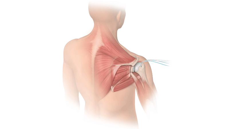 Diagnostic Arthroscopy