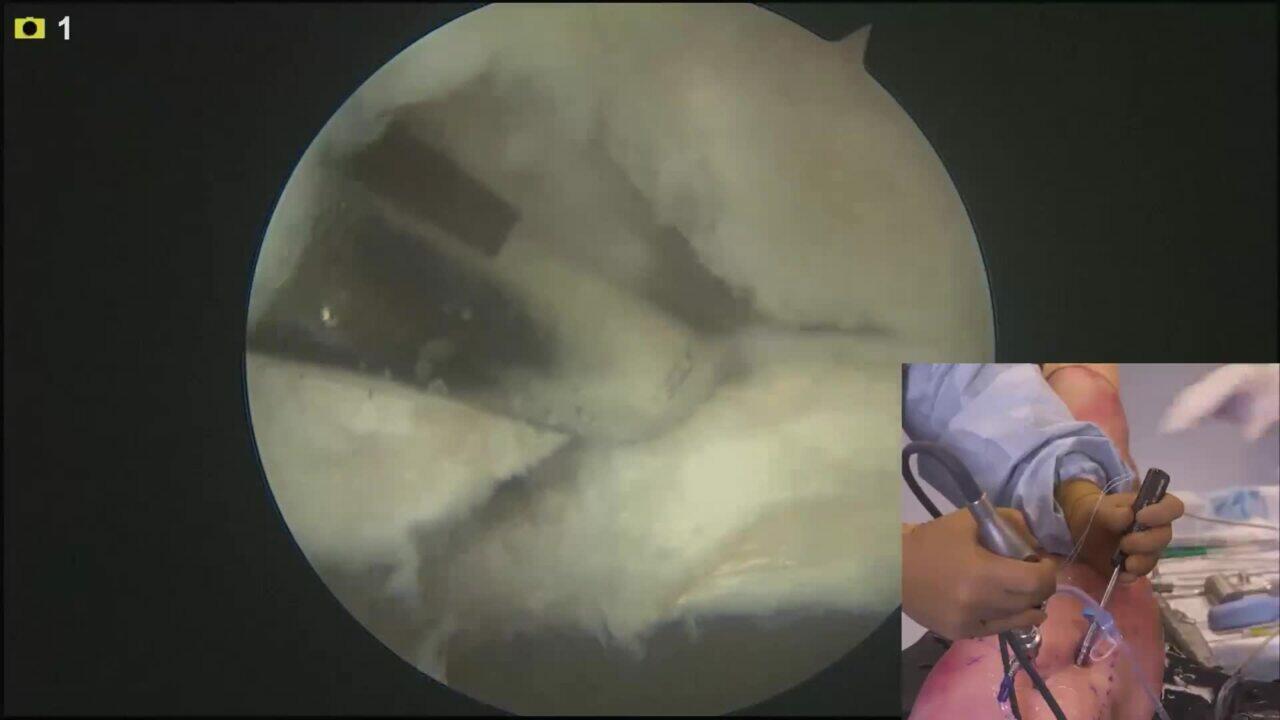 Hip Labral Repair using the VERSALOOP Soft Anchor Presented by: Sean McMillan