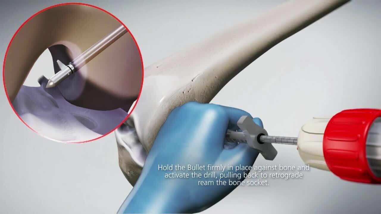 Innovation in Soft Tissue ACL Reconstruction & Meniscal Repair Video