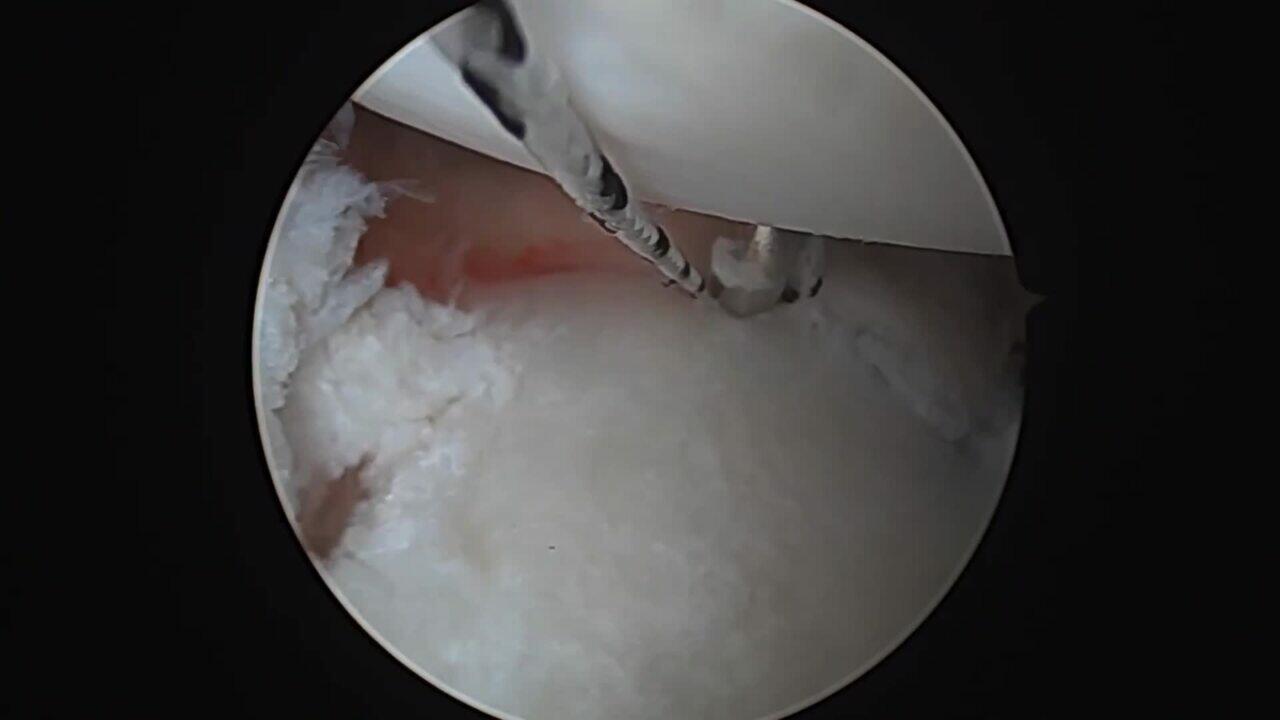 VERSALOOP Surgical Video -Shoulder Labral Repair & Remplissage with Dr. Eric McCarty