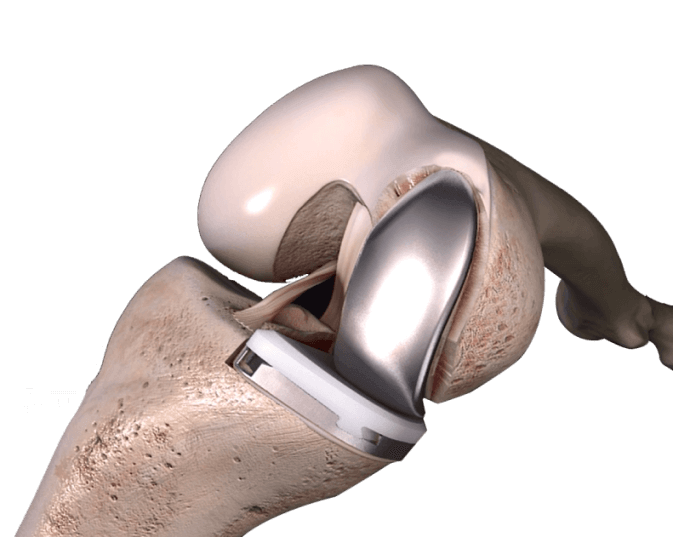 The SIGMA HP Partial Knee is a high ﬂex Fixed Bearing Unicompartmental Knee that is designed to provide solutions for any area of the knee depending on the degree of arthritis damage and includes femoral and tibia components.