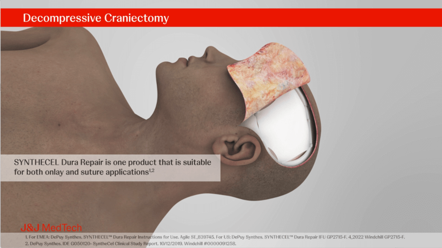 Decompressive Craniectomy