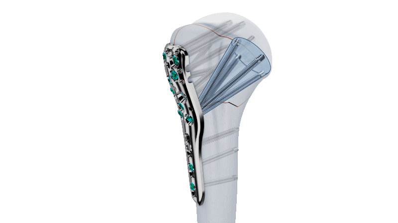 VOLT Proximal Humerus Plate on bone