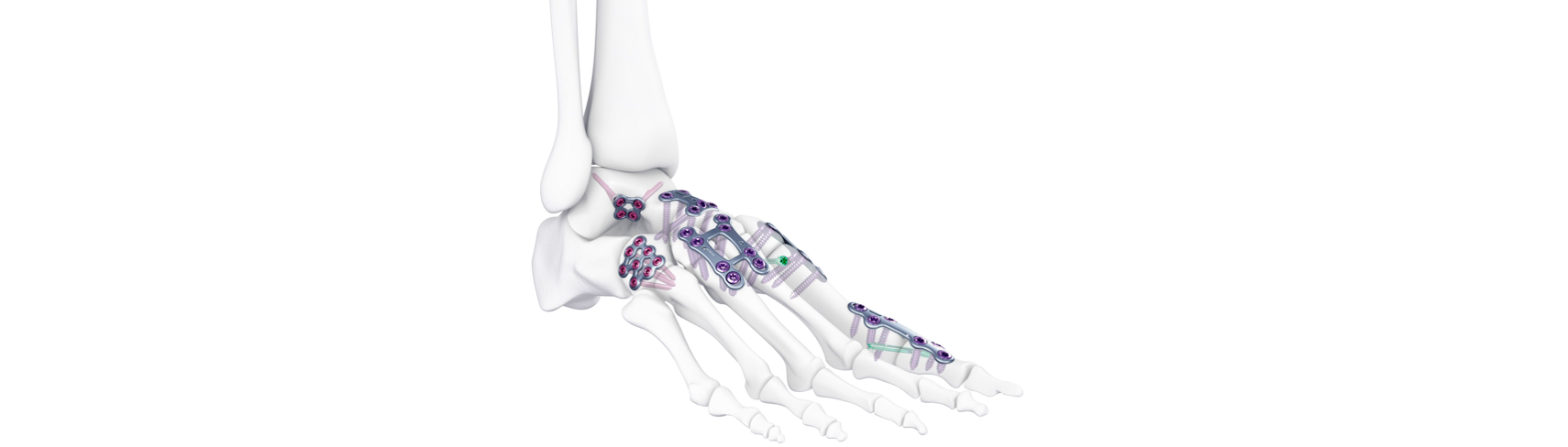 plates on foot