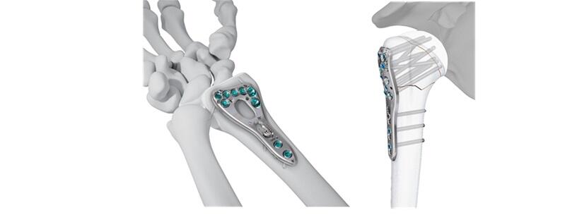 VOLT™ Wrist and Proximal Humerus Plating Systems