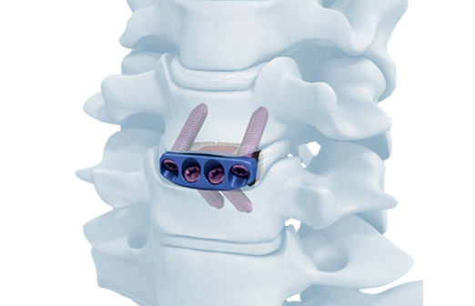 ZERO-P®