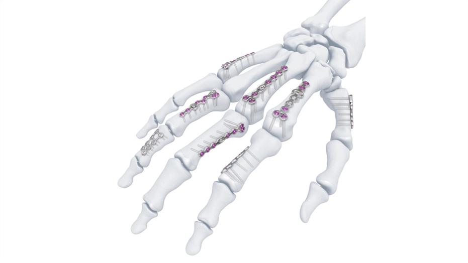 Variable Angle Locking Hand System shown in place in bones of the hand