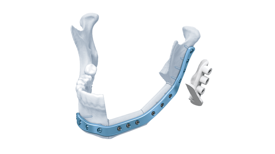 TRUMATCH CMF Titanium 3D Milled Plates for Mandible shown in place attached to human mandible bone and the matching surgical guide*