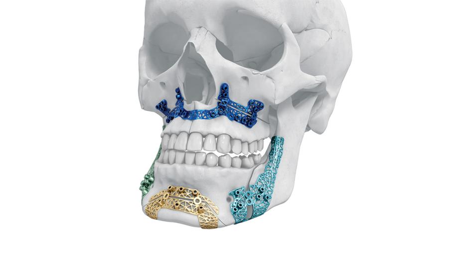 Human skull showcasing orthognathic TRUMATCH CMF Titanium 3D Printed Guides