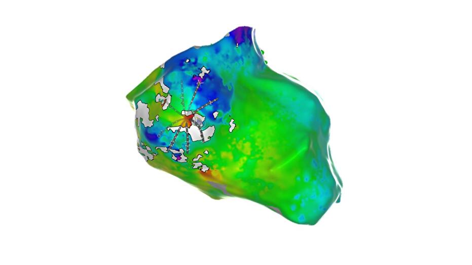 Late Annotation Mapping Module for late potentials in VT