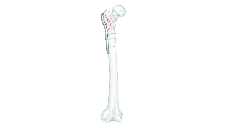Proximal Femoral Plate attached to bone