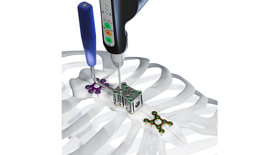 The MatrixSTERNUM Fixation System shown being affixed to the sternal bone