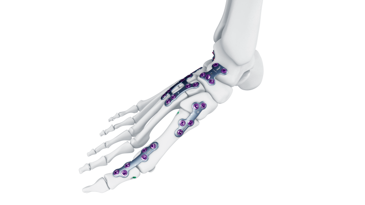 TriLEAP Plating System with multiple anatomic plate options around a foot 